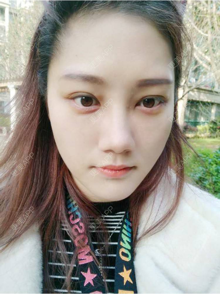 更美 - 玻璃之情的外切去眼袋经验 | 外切去眼袋 | 外切去眼袋 | 武汉