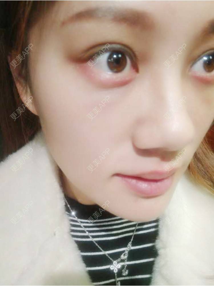 更美 - 玻璃之情的外切去眼袋经验 | 外切去眼袋 | 外切去眼袋 | 武汉
