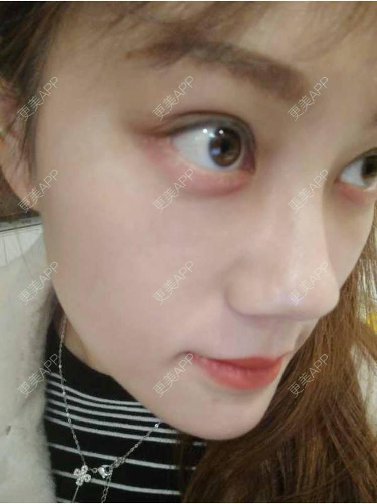 更美 - 玻璃之情的外切去眼袋经验 | 外切去眼袋 | 外切去眼袋 | 武汉