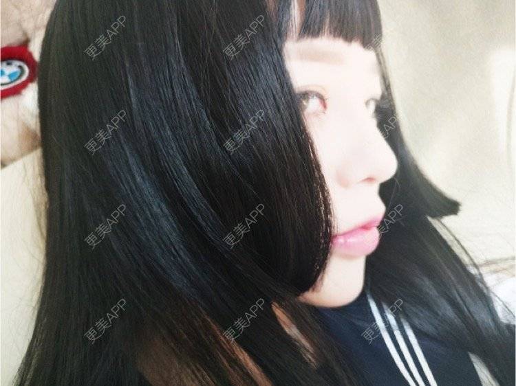 更美 - liu Lisa的鼻部多项经验 | 成都 | 鼻综合手术 | 隆鼻修复