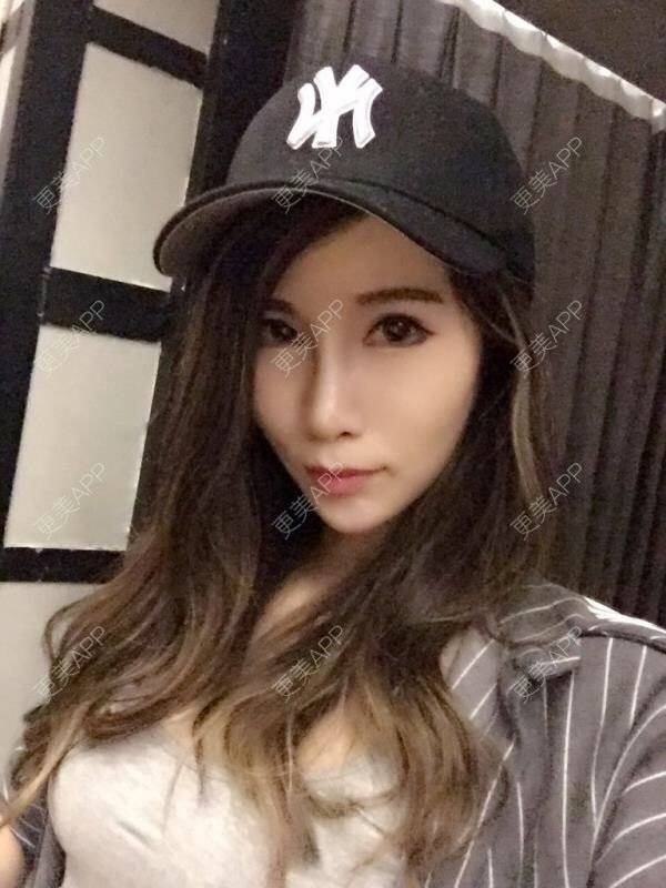 更美 - 更美用户4K3Ott4EaC的埋线提升经验 | 视频日记 | 埋线提升 | 成都