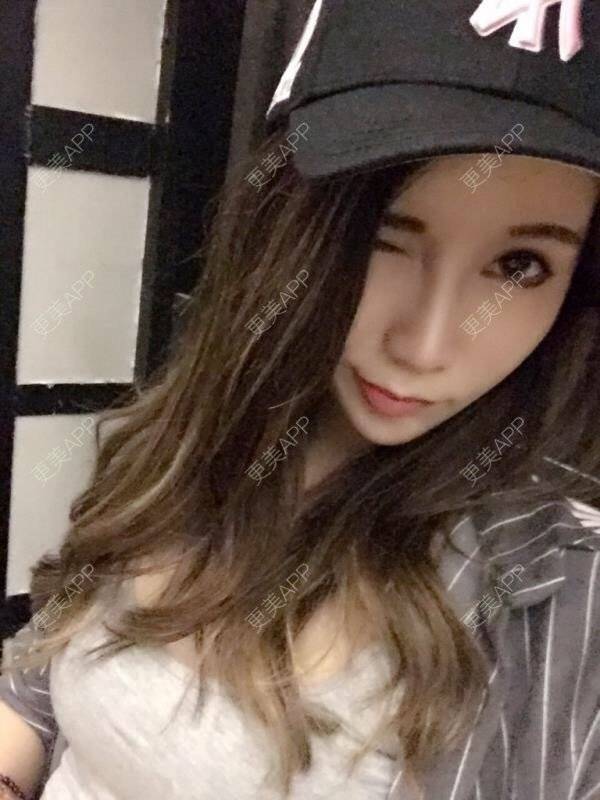 更美 - 更美用户4K3Ott4EaC的埋线提升经验 | 视频日记 | 埋线提升 | 成都