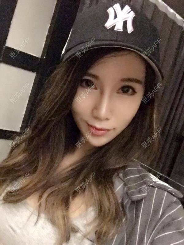 更美 - 更美用户4K3Ott4EaC的埋线提升经验 | 视频日记 | 埋线提升 | 成都