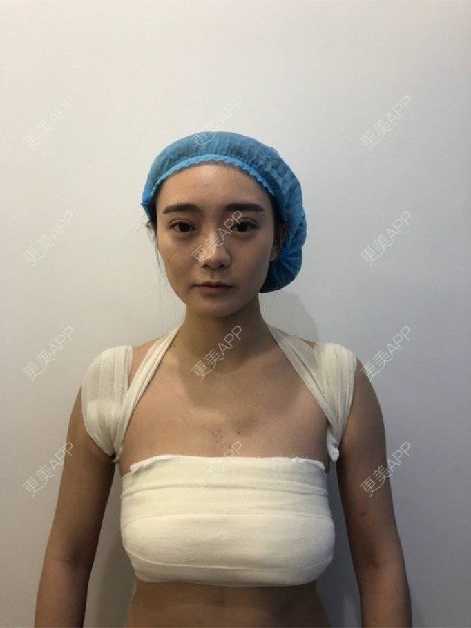 因为绷带原因,睡觉睡到半夜总会醒一次,断断续续的睡,还有4天才能拆掉