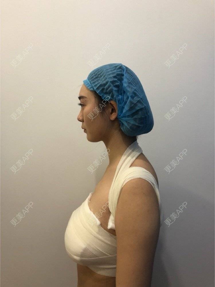 香蕉牛奶咖啡的假体隆胸日记