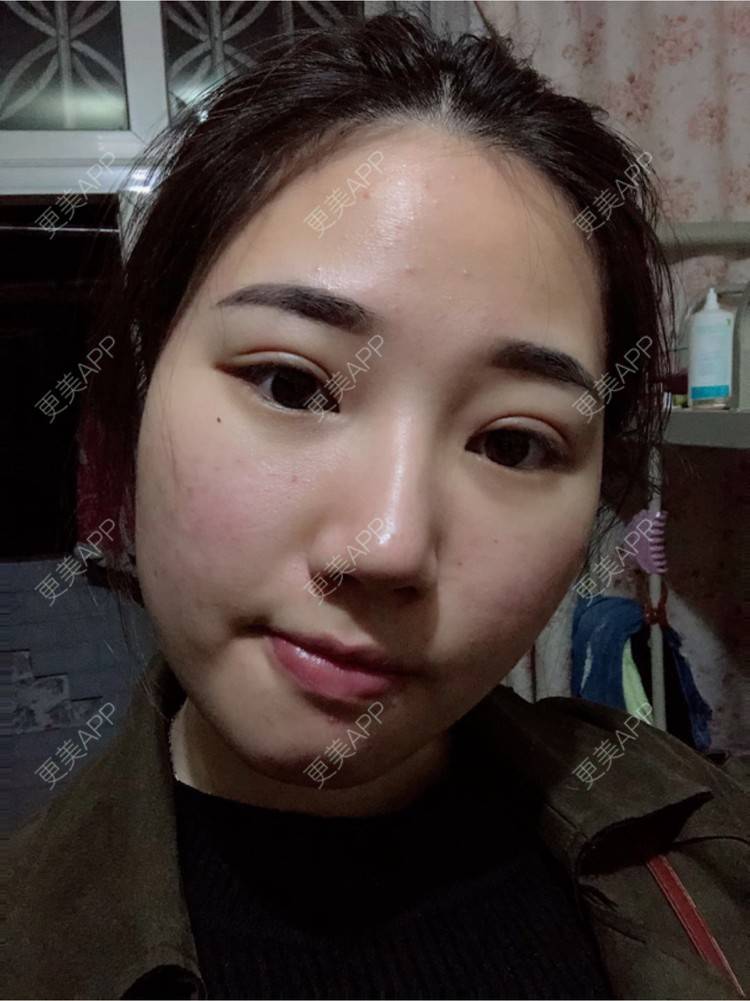 更美 - 用桶喝水的经验 | OPT激光祛痘 | 消炎祛痘 | 武汉