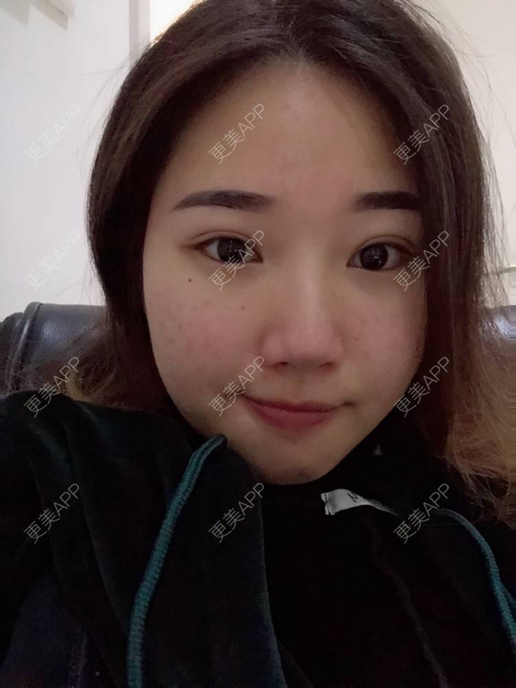 更美 - 用桶喝水的经验 | OPT激光祛痘 | 消炎祛痘 | 武汉
