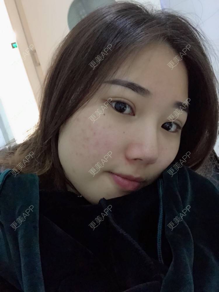 更美 - 用桶喝水的经验 | OPT激光祛痘 | 消炎祛痘 | 武汉