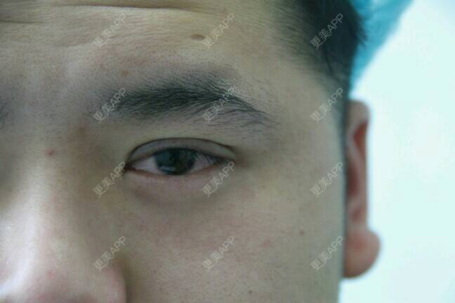 更美 - 更美用户BrpU6zP0GB的埋线双眼皮经验 | 厦门 | 埋线双眼皮