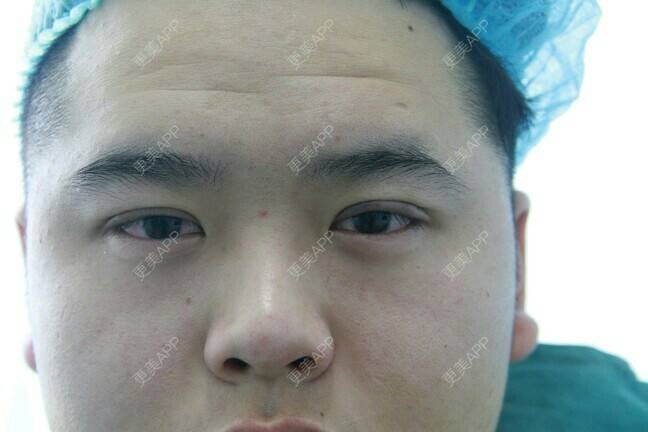 更美 - 更美用户BrpU6zP0GB的埋线双眼皮经验 | 厦门 | 埋线双眼皮