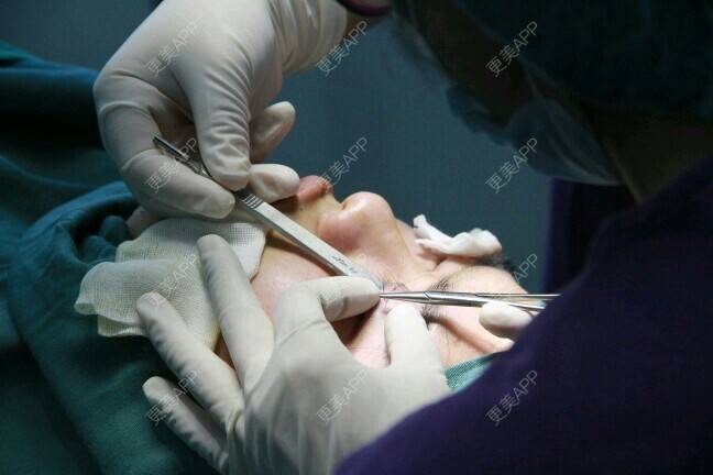 更美 - 更美用户BrpU6zP0GB的埋线双眼皮经验 | 厦门 | 埋线双眼皮