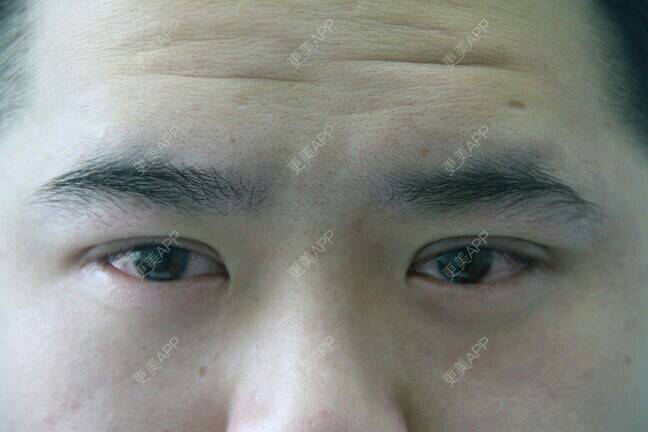 更美 - 更美用户BrpU6zP0GB的埋线双眼皮经验 | 厦门 | 埋线双眼皮