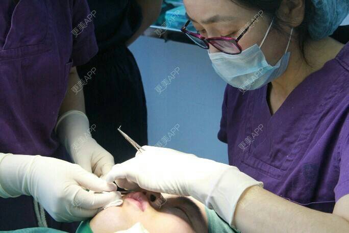 更美 - 更美用户BrpU6zP0GB的埋线双眼皮经验 | 厦门 | 埋线双眼皮