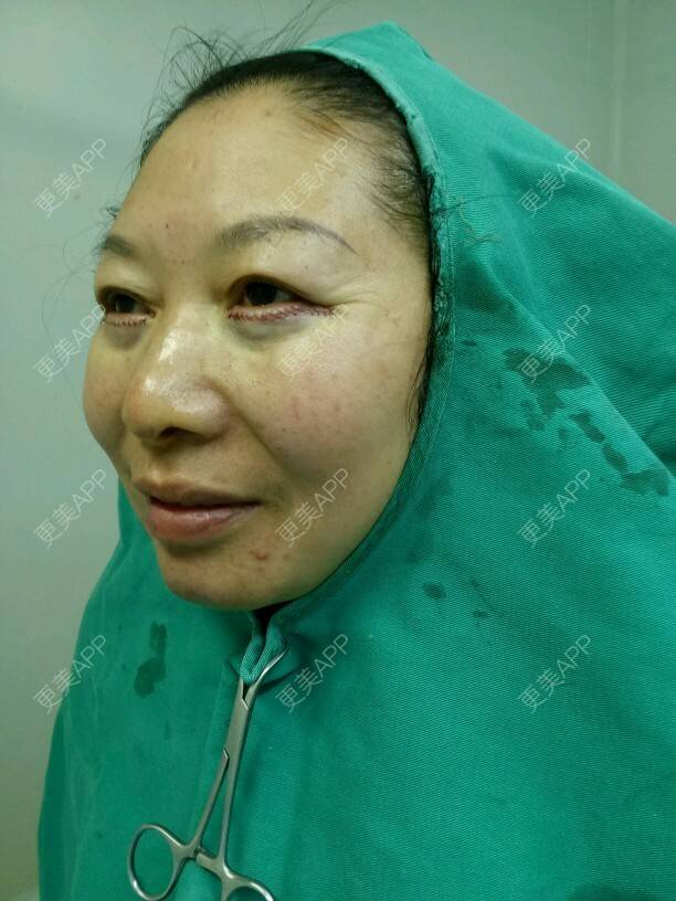 菢菂媄亽归﹏的外切去眼袋日记