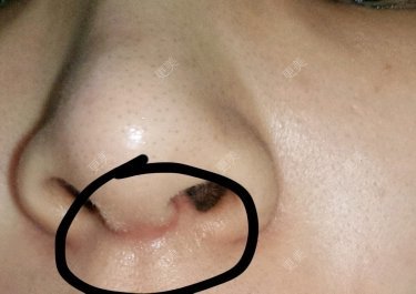 鼻小柱两旁有两个白色的小包