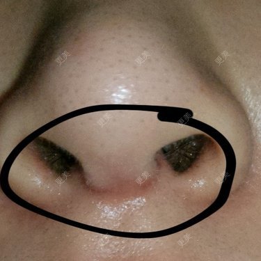 鼻小柱两旁有两个白色的小包