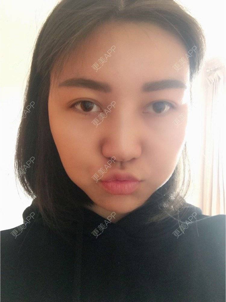 更美 - 翟杨 医生的隆鼻经验 | 西安 | 隆鼻