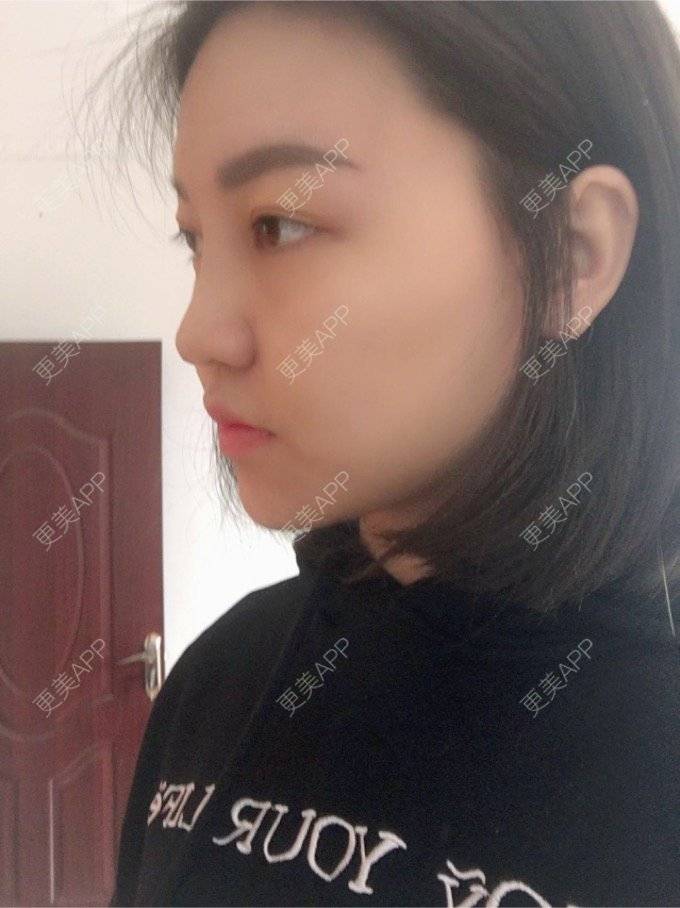 更美 - 翟杨 医生的隆鼻经验 | 西安 | 隆鼻