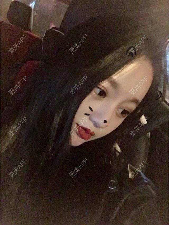 更美 - 妮妮小仙女的唇腭裂修复经验 | 玻尿酸唇部 | 重庆 | 丰唇珠
