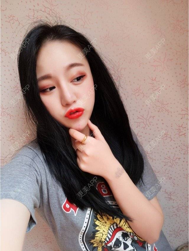 更美 - 妮妮小仙女的唇腭裂修复经验 | 玻尿酸唇部 | 重庆 | 丰唇珠