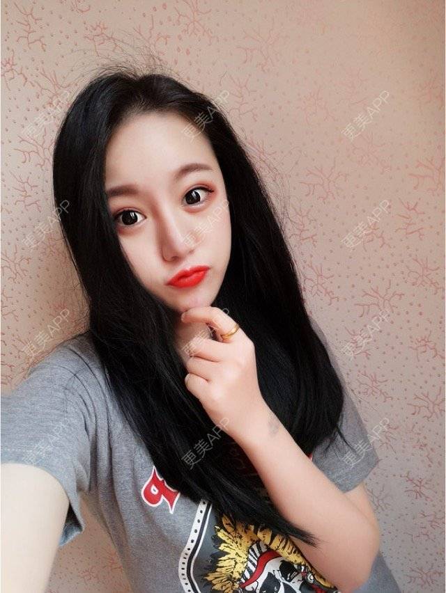 更美 - 妮妮小仙女的唇腭裂修复经验 | 玻尿酸唇部 | 重庆 | 丰唇珠