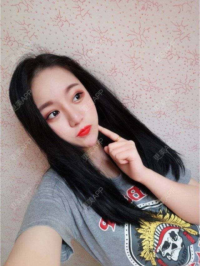 更美 - 妮妮小仙女的唇腭裂修复经验 | 玻尿酸唇部 | 重庆 | 丰唇珠
