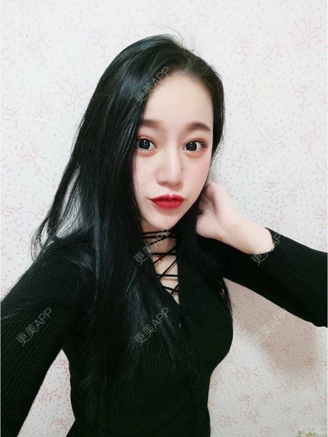 更美 - 妮妮小仙女的唇腭裂修复经验 | 玻尿酸唇部 | 重庆 | 丰唇珠