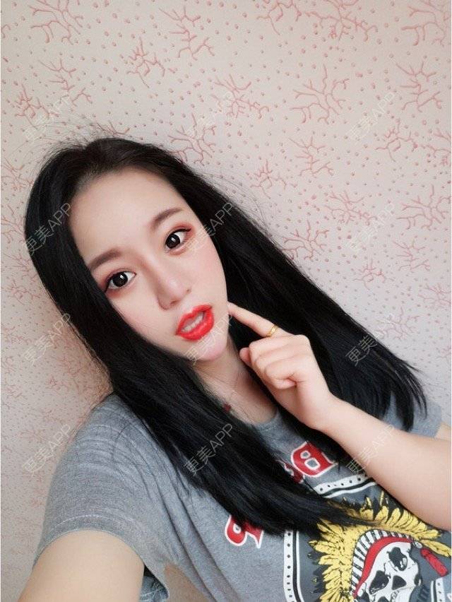 更美 - 妮妮小仙女的唇腭裂修复经验 | 玻尿酸唇部 | 重庆 | 丰唇珠