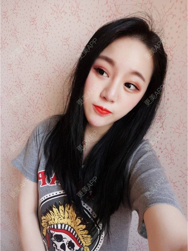 更美 - 妮妮小仙女的唇腭裂修复经验 | 玻尿酸唇部 | 重庆 | 丰唇珠