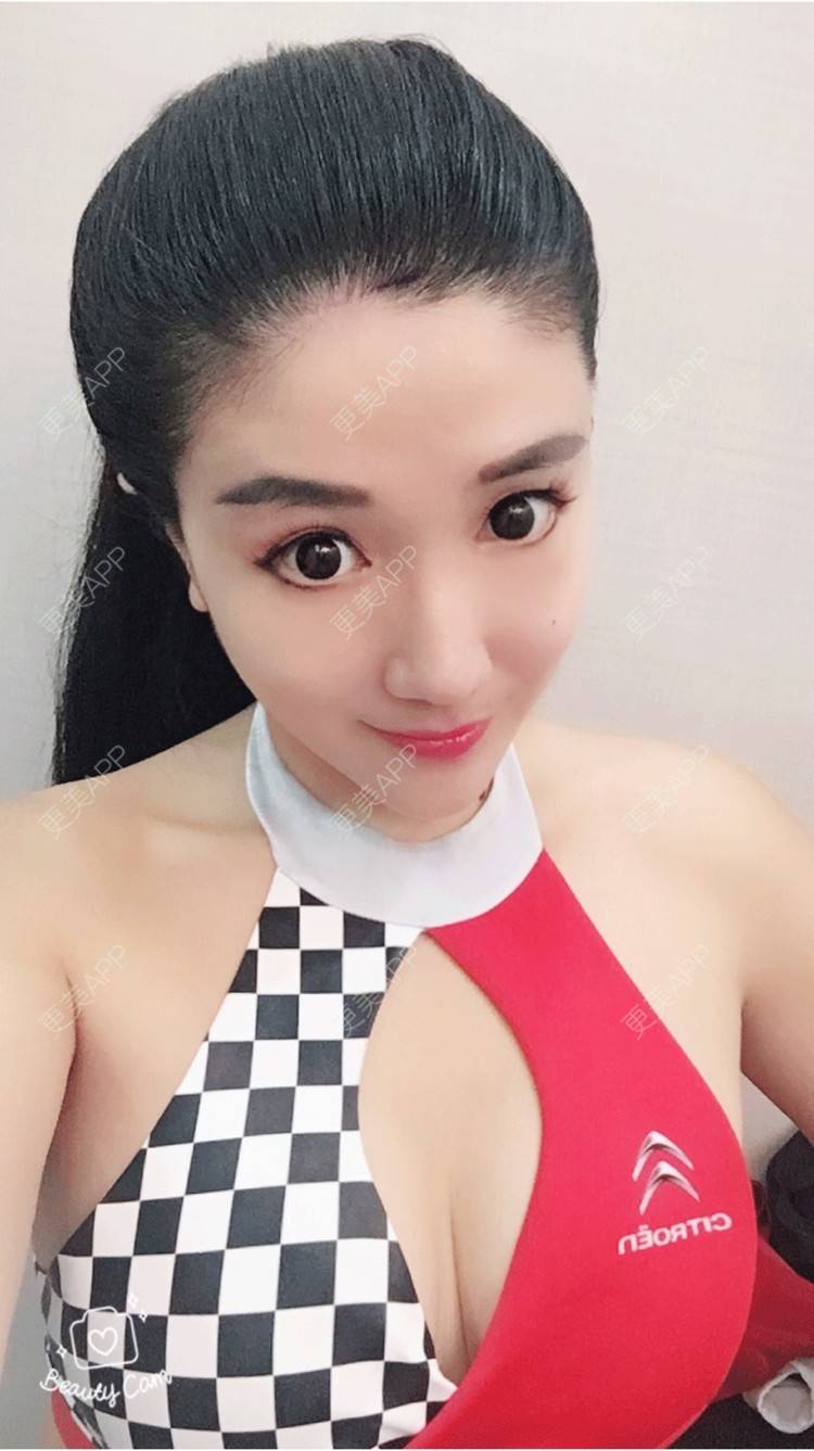 更美 - 晴欢少女的埋线提升经验 | 北京 | 埋线提升 | 埋线除皱