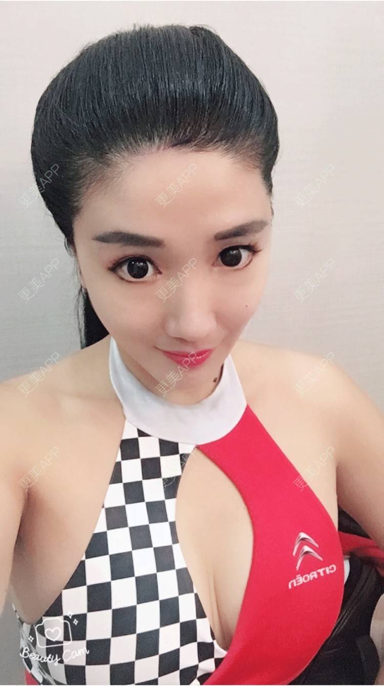 更美 - 晴欢少女的埋线提升经验 | 北京 | 埋线提升 | 埋线除皱