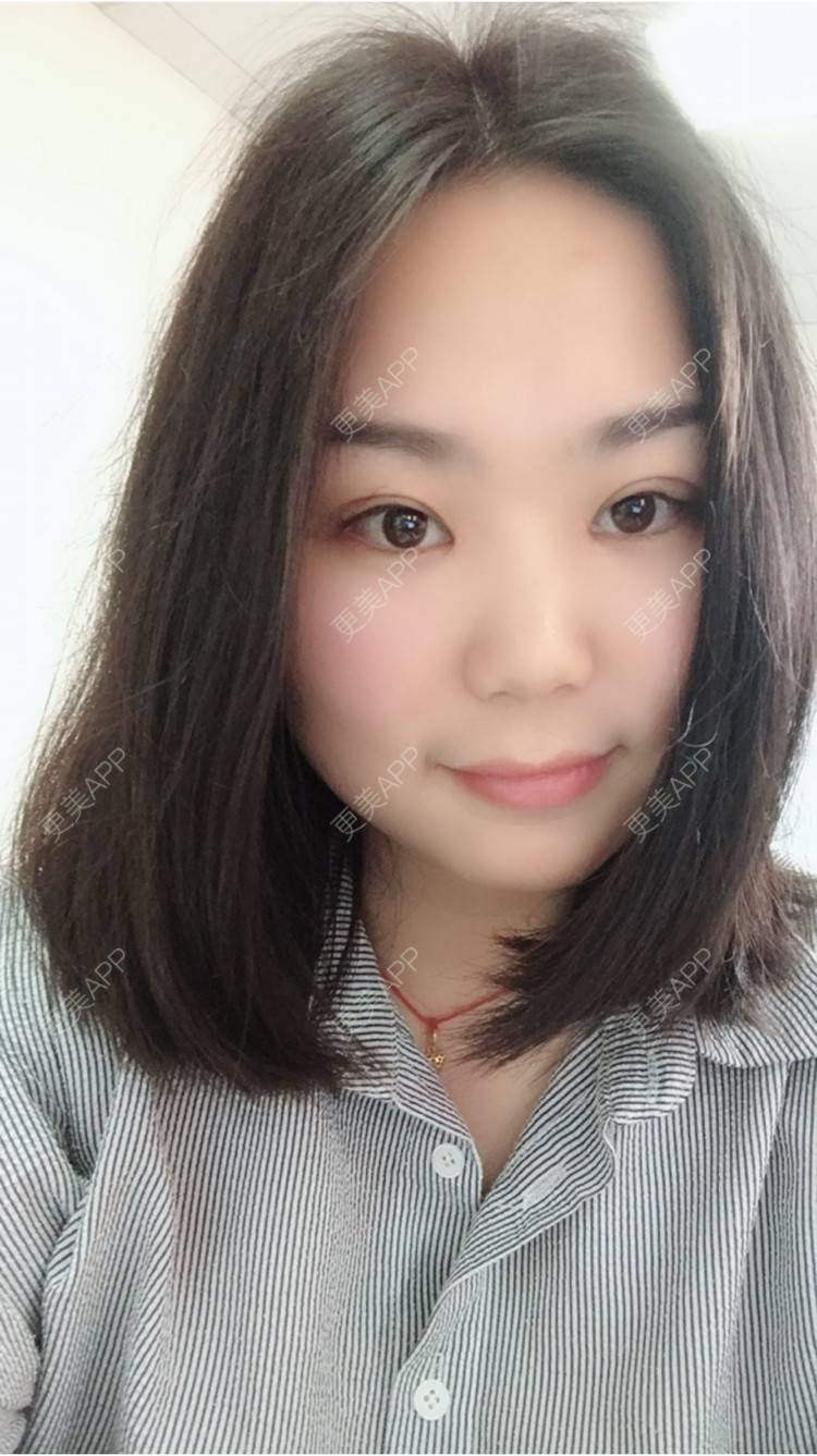 低鼻梁的小女生的双眼皮日记