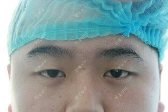 更美 - 更美用户BrpU6zP0GB的埋线双眼皮经验 | 厦门 | 埋线双眼皮