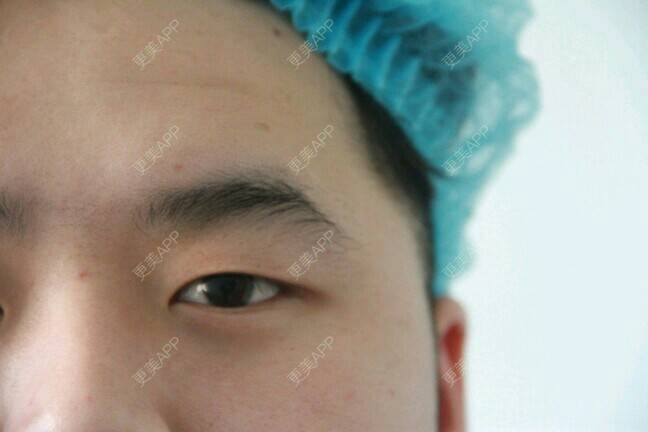 更美 - 更美用户BrpU6zP0GB的埋线双眼皮经验 | 厦门 | 埋线双眼皮