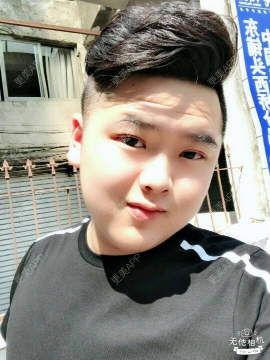 更美 - 更美用户BrpU6zP0GB的埋线双眼皮经验 | 厦门 | 埋线双眼皮