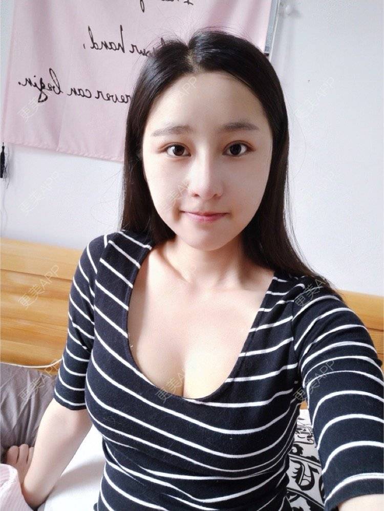 更美 - monkey1234的自体脂肪隆胸经验 | 成都 | 自体脂肪隆胸 | 视频日记