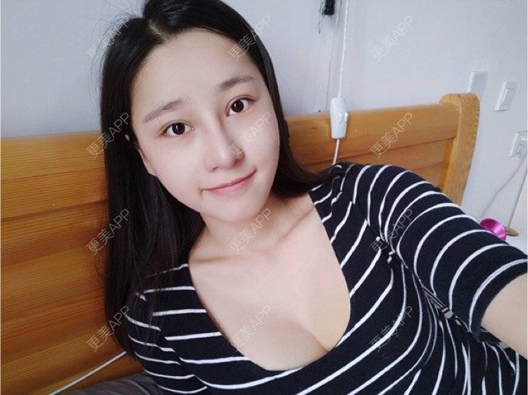 更美 - monkey1234的自体脂肪隆胸经验 | 成都 | 自体脂肪隆胸 | 视频日记