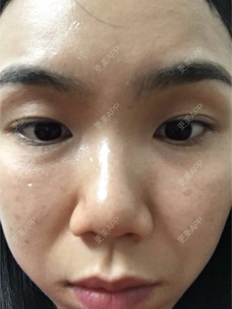 更美 - 大头哈－猪的颈部经验 | 眼部细纹 | 广州 | 颈部