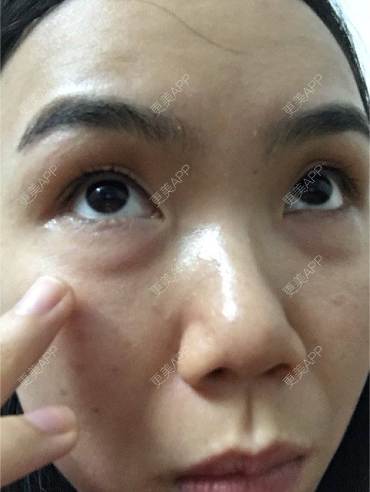 更美 - 大头哈－猪的颈部经验 | 眼部细纹 | 广州 | 颈部