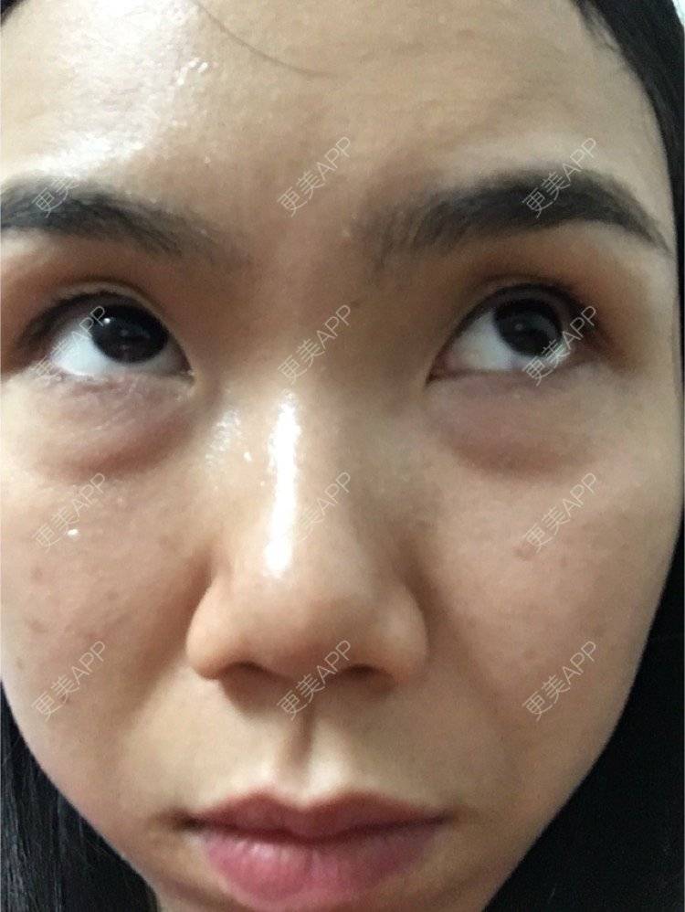 更美 - 大头哈－猪的颈部经验 | 眼部细纹 | 广州 | 颈部