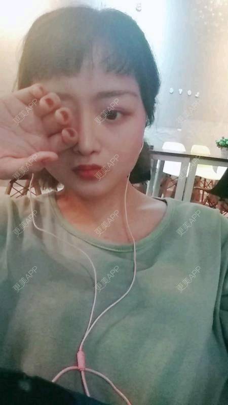 更美 - 米格m的鼻部多项经验 | 膨体隆鼻 | 广州 | 隆鼻 | 鼻部多项