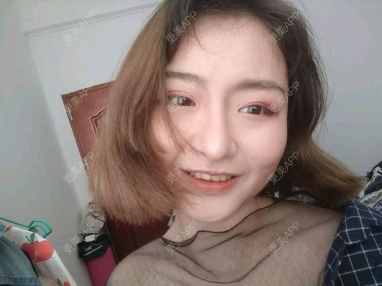 更美 - 米格m的鼻部多项经验 | 膨体隆鼻 | 广州 | 隆鼻 | 鼻部多项