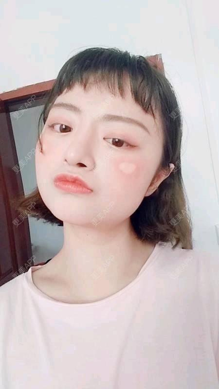 更美 - 米格m的鼻部多项经验 | 膨体隆鼻 | 广州 | 隆鼻 | 鼻部多项