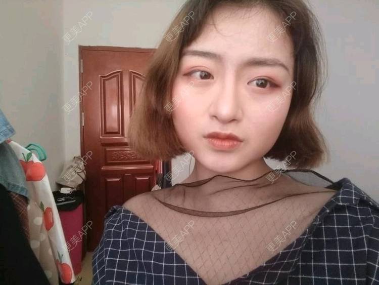 更美 - 米格m的鼻部多项经验 | 膨体隆鼻 | 广州 | 隆鼻 | 鼻部多项