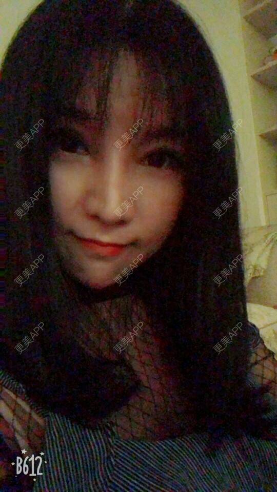 更美 - 更美用户cuJZLDzBlB的埋线提升经验 | 埋线提升 | 埋线除皱 | 武汉
