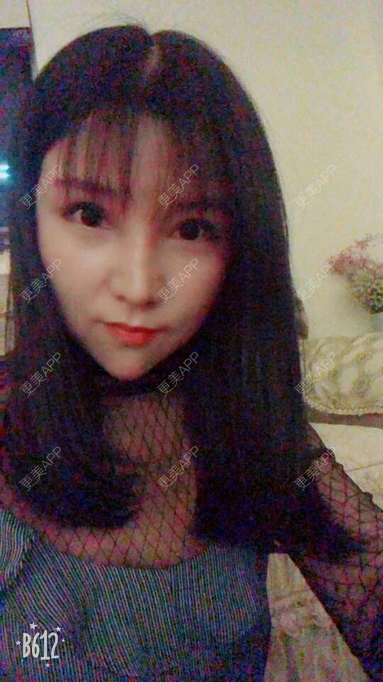 更美 - 更美用户cuJZLDzBlB的埋线提升经验 | 埋线提升 | 埋线除皱 | 武汉