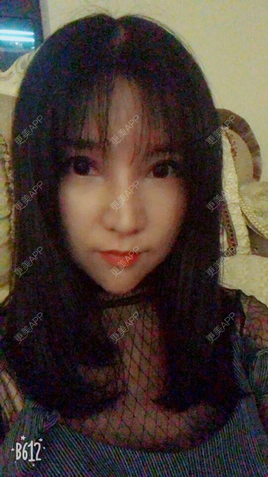 更美 - 更美用户cuJZLDzBlB的埋线提升经验 | 埋线提升 | 埋线除皱 | 武汉