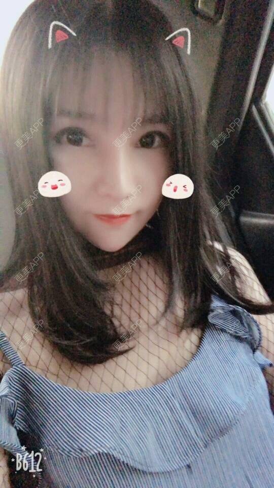 更美 - 更美用户cuJZLDzBlB的埋线提升经验 | 埋线提升 | 埋线除皱 | 武汉