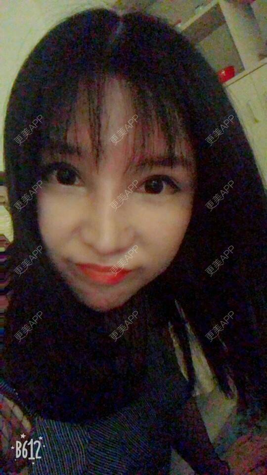 更美 - 更美用户cuJZLDzBlB的埋线提升经验 | 埋线提升 | 埋线除皱 | 武汉