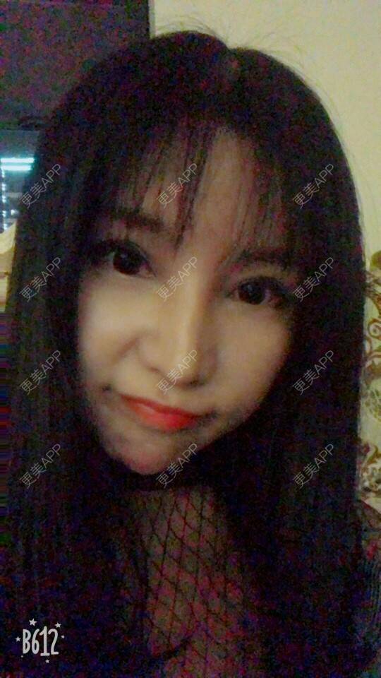 更美 - 更美用户cuJZLDzBlB的埋线提升经验 | 埋线提升 | 埋线除皱 | 武汉